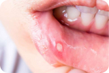 Insight: Oral Complications & Systemic Diseases