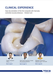 VOCO VisCalor bulk - Case documentation of the first composite with thermally controlled viscosity behaviour