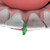 Fusion Anterior Interproximal Wedge - Pack of 100 Refills