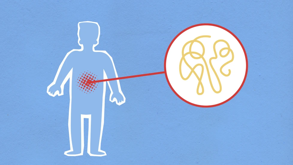Study: L. acidophilus Outperforms Other Probiotics for IBS Abdominal Pain Relief