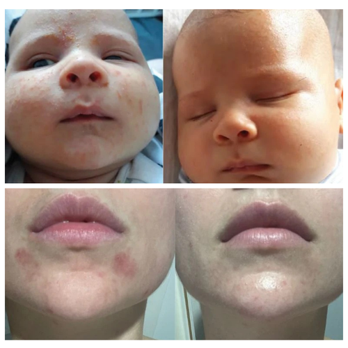 Before and After Use of Allergoff Atopy