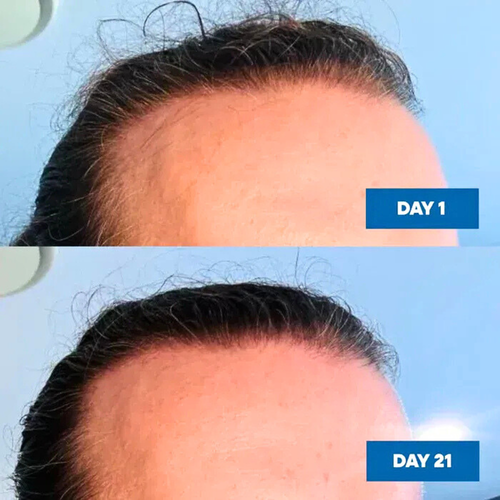 MOOGOO Natural Hair Growth Serum 30mL results with before and after