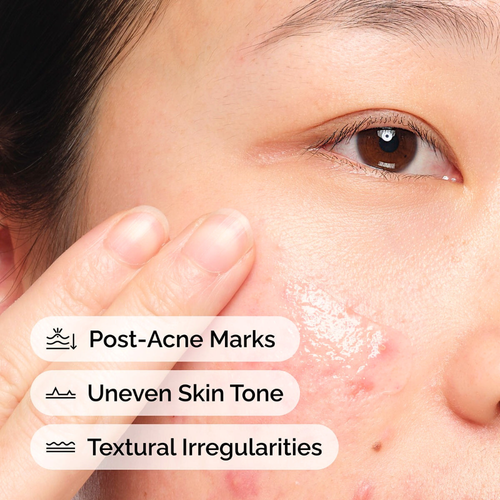 The Ordinary Aloe 2% + NAG 2% Solution Post-Acne Marks Reduction Serum 30mL product features with model demo image