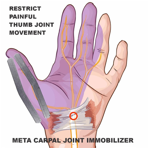 An anatomical illustration of a hand showing the nerves and ligaments