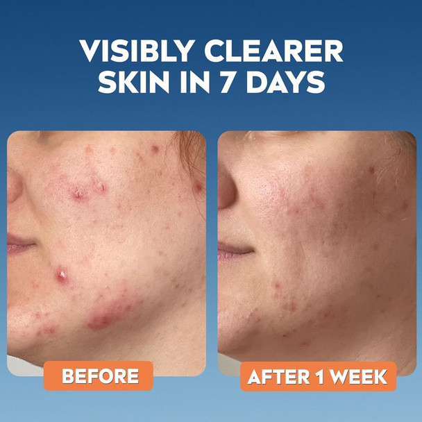 Nivea Derma Skin Anti-Imperfection Scrub 150 ml