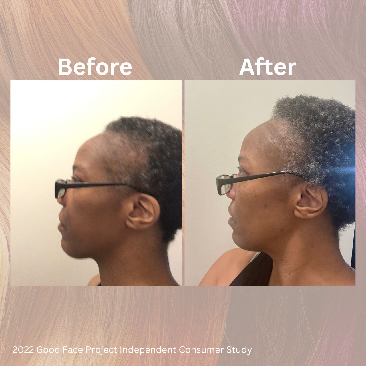 Results from Skin Actives Hair Growth Study