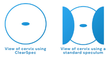 ClearSpec Single Use Vaginal Speculum with Sheath view when in use