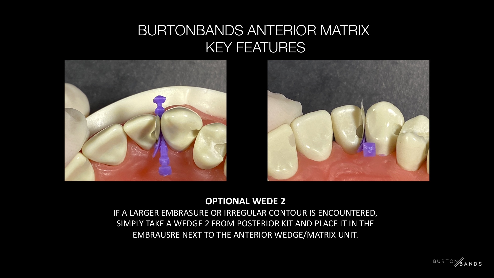 BURTONBANDS ANTERIOR HOW THEY WORK