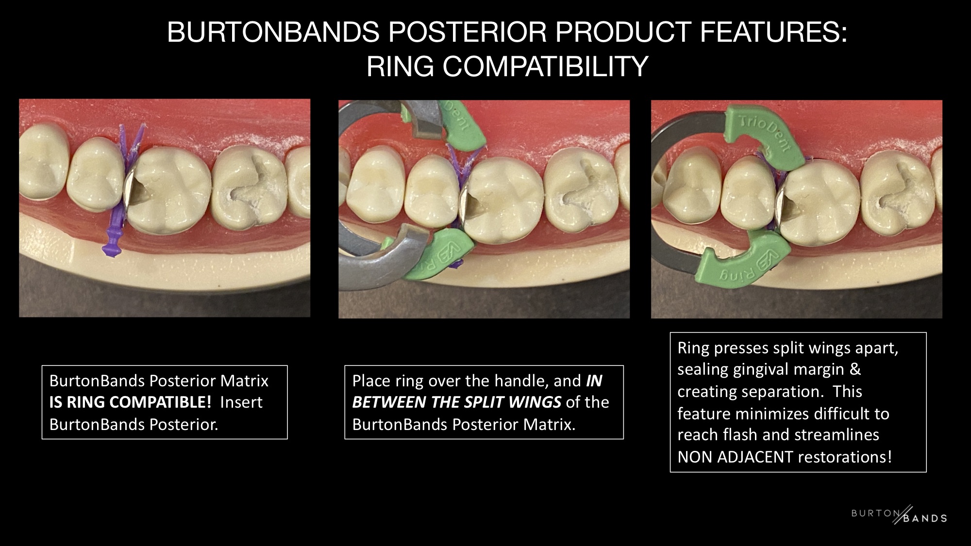 HOW BURTONBANDS POSTERIOR WORKS