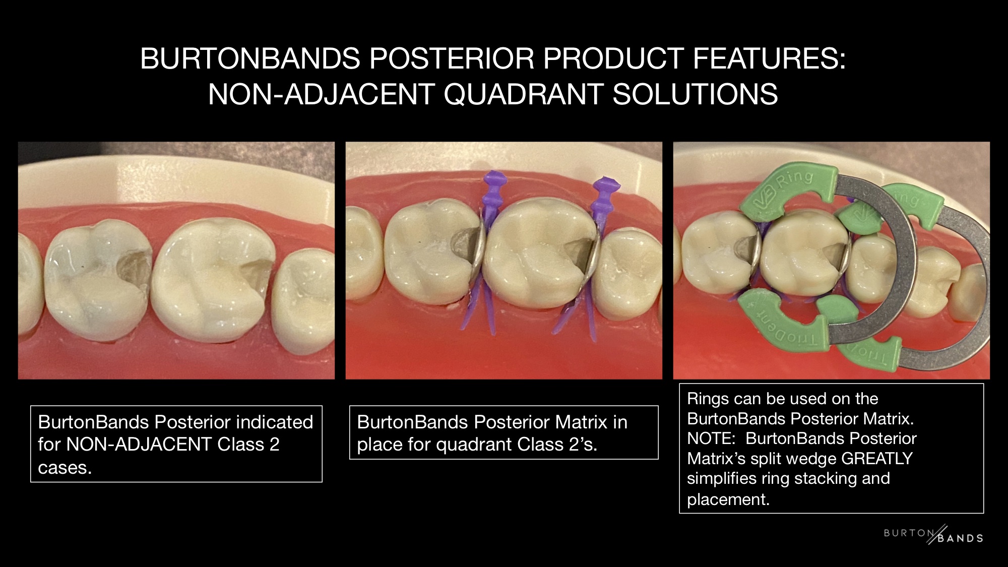 HOW BURTONBANDS POSTERIOR WORKS