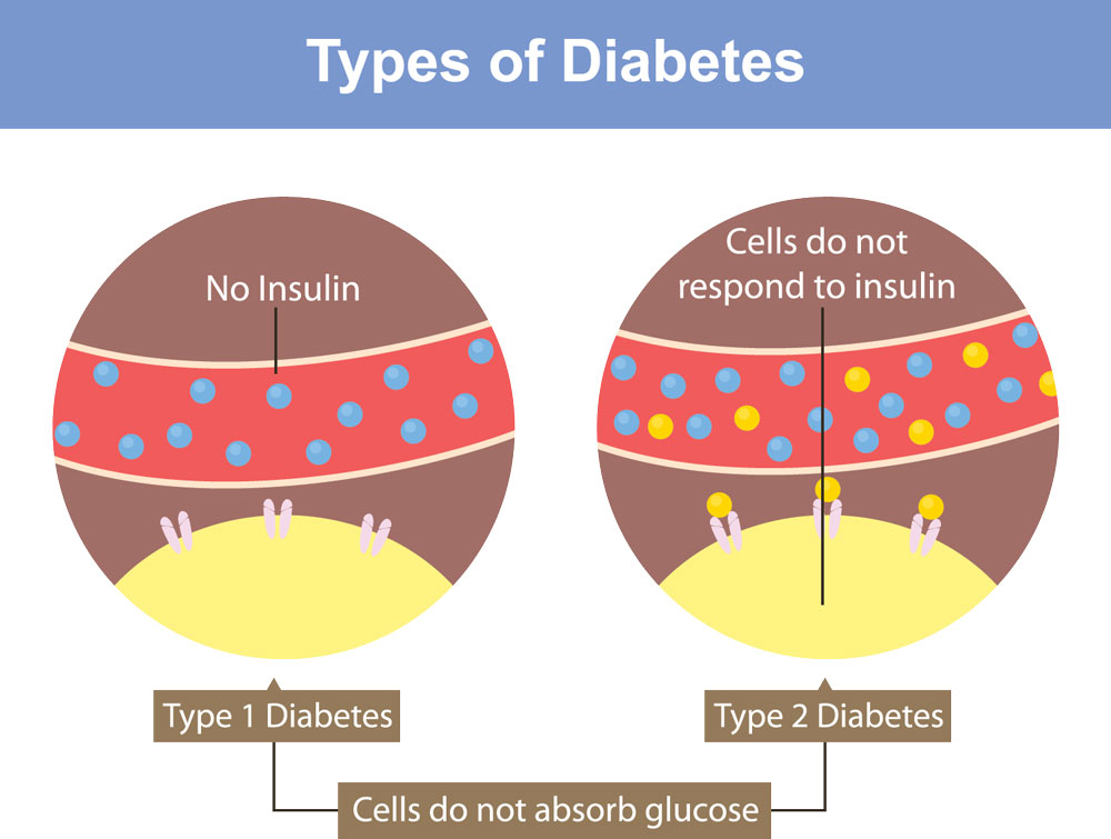 Type 1 Vs Type 2 