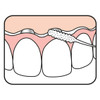 Tepe Bridge and Implant Floss cartoon use of use on anterior teeth