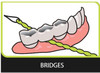 Idontix X-Floss Easy Bridge and Implant Floss - 30 Strands view of use with dental bridges