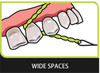 Idontix X-Floss Easy Bridge and Implant Floss - 30 Strands view of with wide tooth spaces