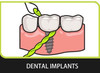Idontix X-Floss Easy Bridge and Implant Floss - 30 Strands view of use with dental implants
