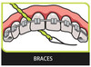 Idontix X-Floss Easy Bridge and Implant Floss - 30 Strands view of of use with orthodontic braces