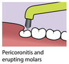 Piksters Curvie Focus Toothbrush view of toothbrush and zoomed view of use for periocoronitis and erupting molars