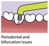 Piksters Curvie Focus Toothbrush view of toothbrush and zoomed view of us on periodontal and bifurcation issues