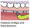 Piksters Curvie Focus Toothbrush: view of the toothbrush and zoomed view of use on dental implants, bridges, and fixed dentures.
