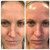 Hydrafacial (Face)