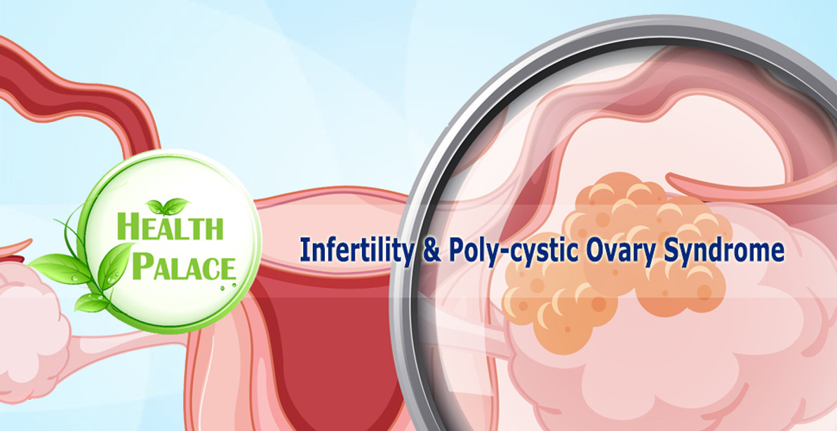 Symptoms of Polycystic Ovarian Syndrome (PCOS) | Natural Supplements for PCOS 