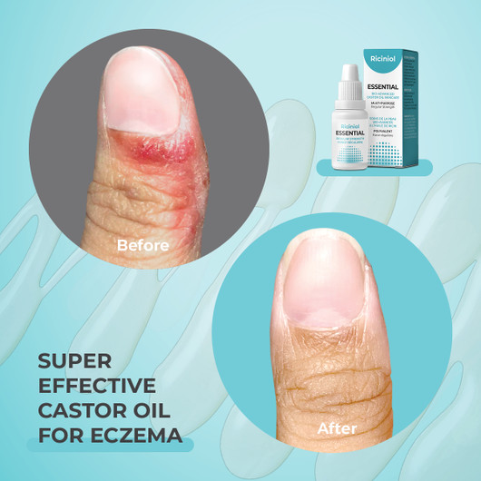 Riciniol Essential Bio Advanced Castor Oil Skincare For eczema