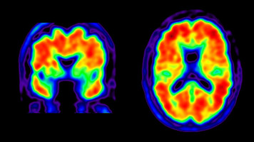 The FDA Has Approved the First New Alzheimer's Disease Treatment in 20 Years