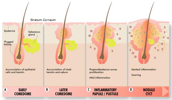 How acne forms