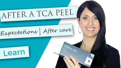 After a TCA Peel | What to Expect | Flaking | Discoloration | Healing | FAQ's