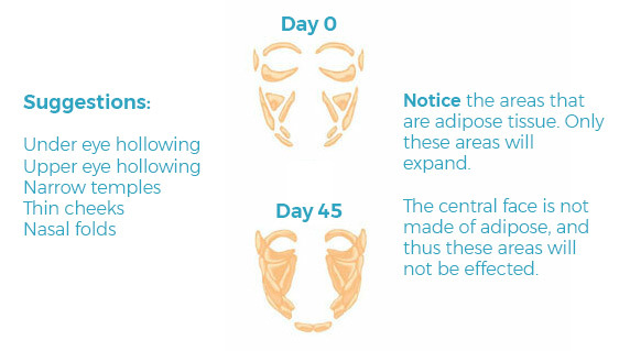 Adipofill'in targets the expansion of adipose tissue. Excellent suggestions are for under eye hollows, upper eye hollowing, thin temples, flat cheeks, nasal folds