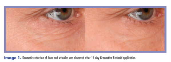 Granactive Retinoid. Dramatic reduction of lines and wrinkles observed after 14 day application