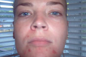 15% salicylic Acid Peel Before