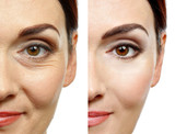 How To Get Rid Of Wrinkles Under Eyes Effectively?