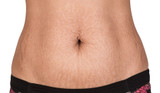 Stretch Marks Don’t Have To Be Stressful Anymore: Find Out How?