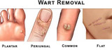 How to Get Rid of Warts Permanently? 