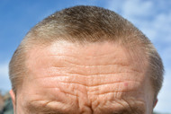 What Causes Furrow lines and How To Treat Them? - Numbskin What Causes Furrow lines and How To Treat Them? - Numbskin