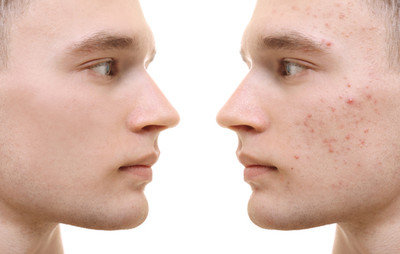 5 Laser Treatments for Treating Your Acne Scars