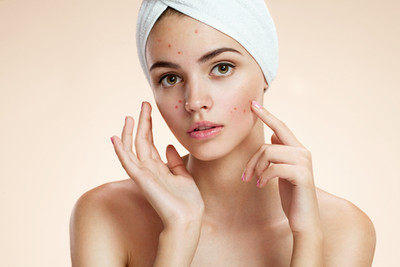 How Can You Effectively Treat Acne Problem In Teens? 