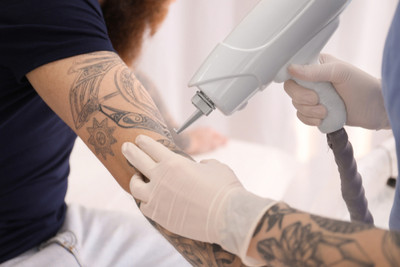 How To Care For Your Skin After Laser Tattoo Removal During Winter?