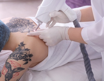 Tattoo Removal Turns Possible With Laser: No More Living With Regret