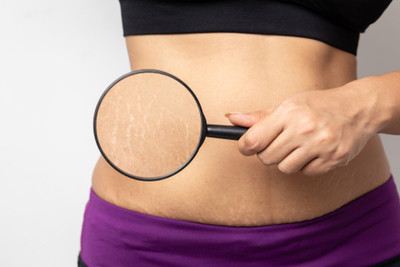 Stretch Marks: Reasons and Solutions