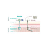 Applied Medical - Miniace - Ace-1425-I - Technology - Enfit Button Antegrade Enema 14 Fr Size 2.5 Cm Length
