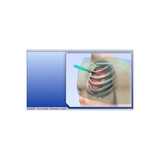 Uresil - Tru-Close - Otw11-13 - Thoracic Vent Procedure Tray Fr.