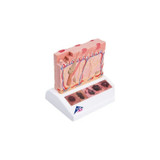 Fabrication Enterprises - 3B Scientific - Z13802 - Skin Cancer Model .44 Lbs.