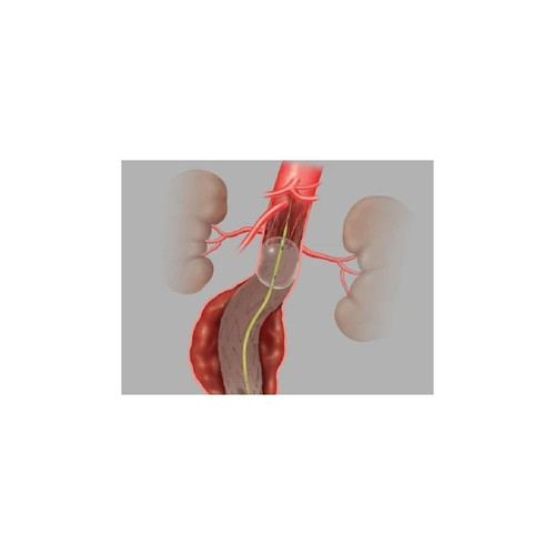 Cook Medical - Coda - G03832 - Lp Balloon Catheters 32 Mm Diameter 100 Cm