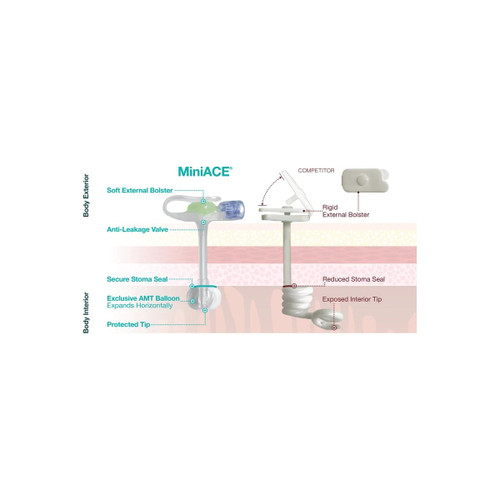 Applied Medical - Miniace - Ace-1044-I - Technology - Enfit Button Antegrade Enema 10 Fr Size 4.4 Cm Length