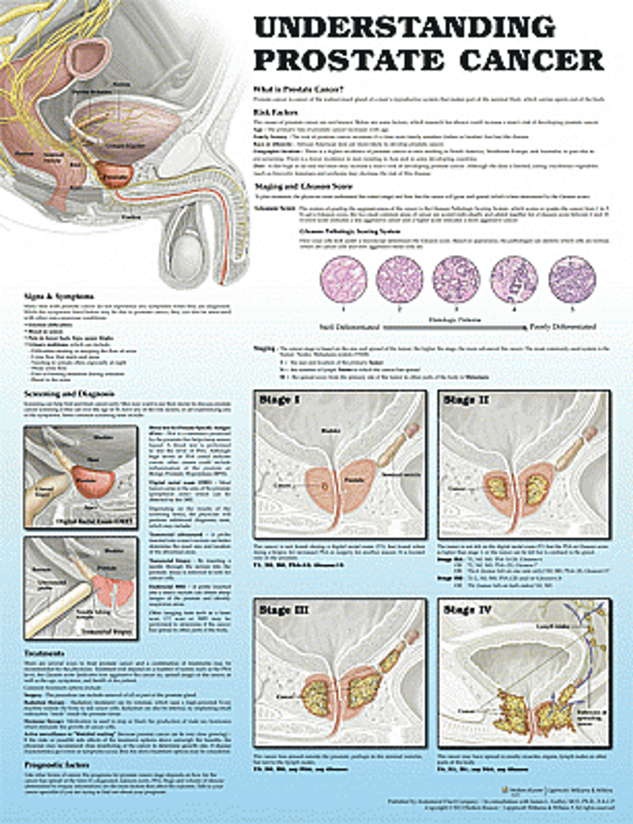 Understanding Prostate Cancer Poster Prostate Cancer Anatomical Chart Co 4611