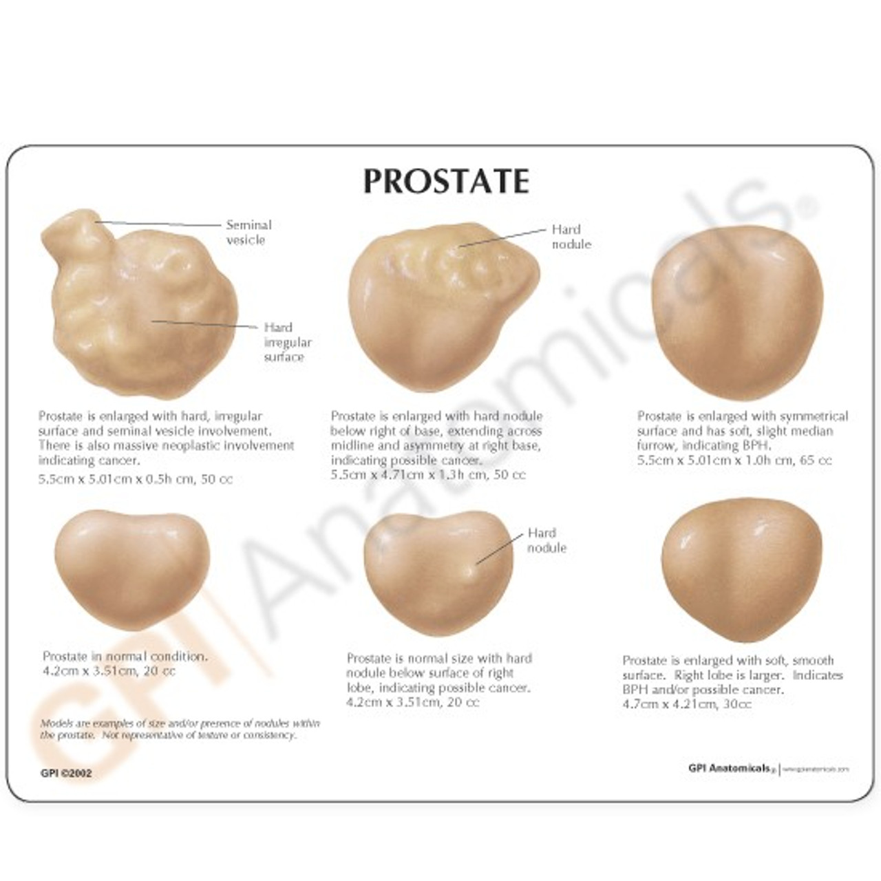 Prostate Conditions Model 3000 Prostate Anatomy Gpi Anatomicals