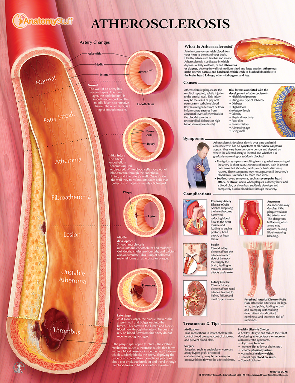 Poster of Atherosclerosis Disease Progression; lipoprot: R&D Systems