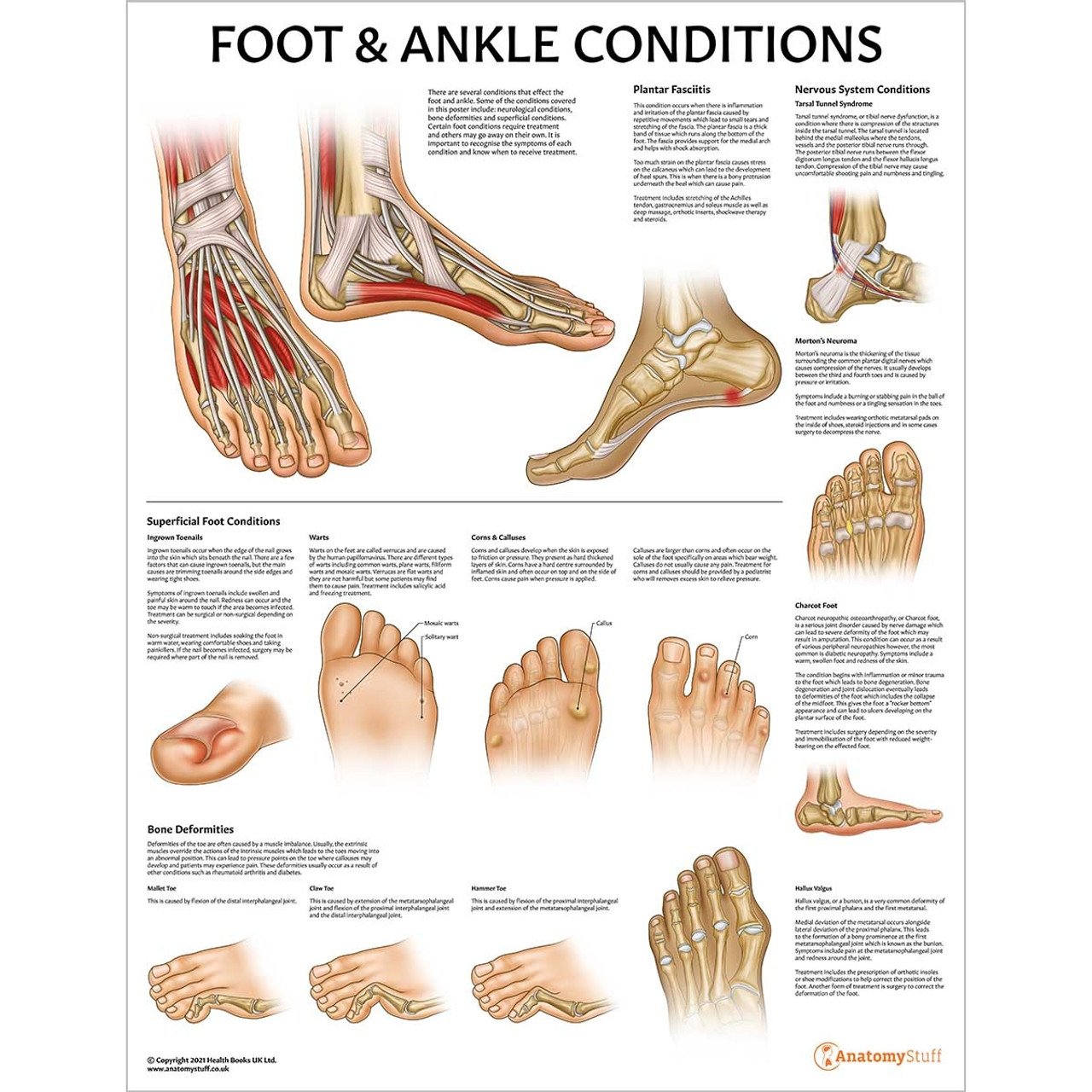 chart foot disease